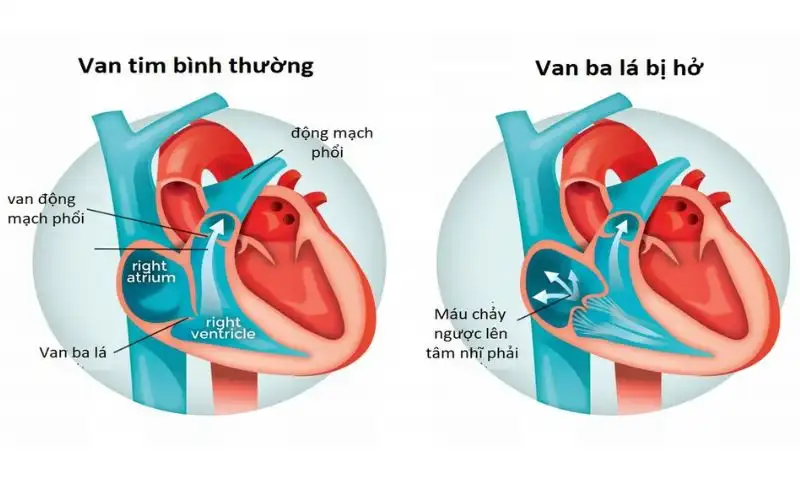 Hình ảnh van tim bình thường và van tim hở 3 lá