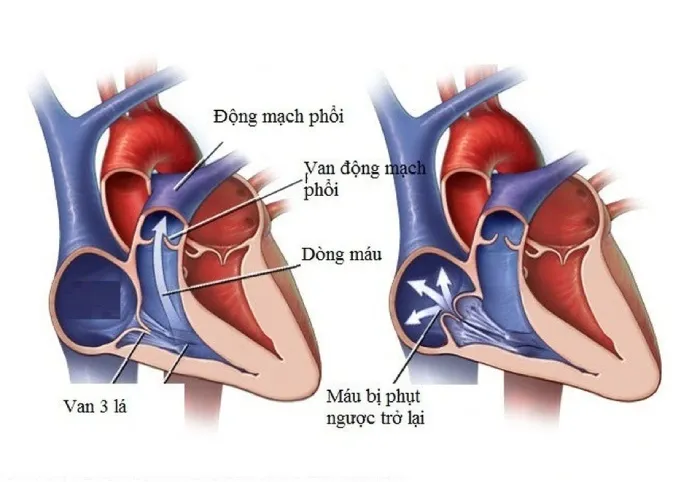 Tổng hợp nguyên nhân của bệnh hở van tim 3 lá 1/4