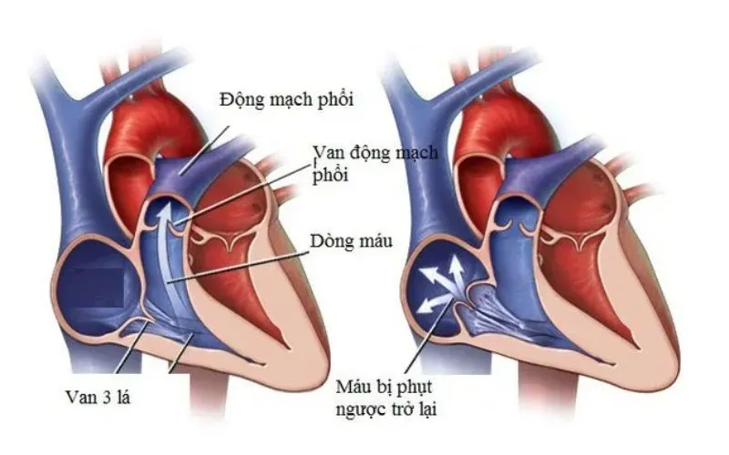 Hở van tim 3 lá 2/4 là mức độ hở trung bình