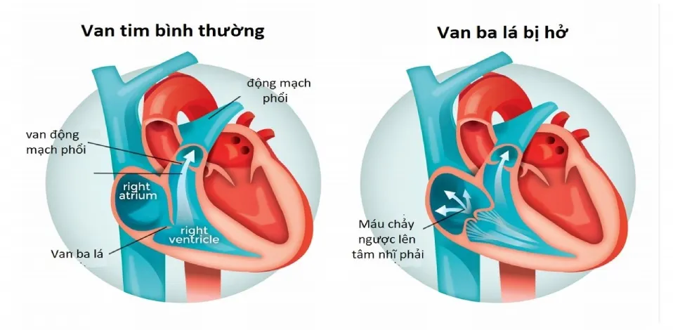 Tìm hiểu về bệnh hở van tim 3 lá 1/4