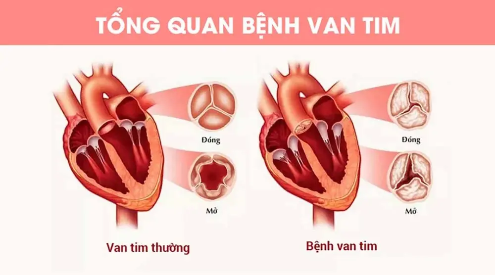 Bệnh hở van tim có di truyền không?