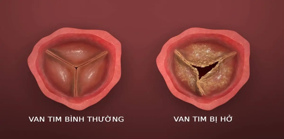 Tìm hiểu về bệnh hở van tim