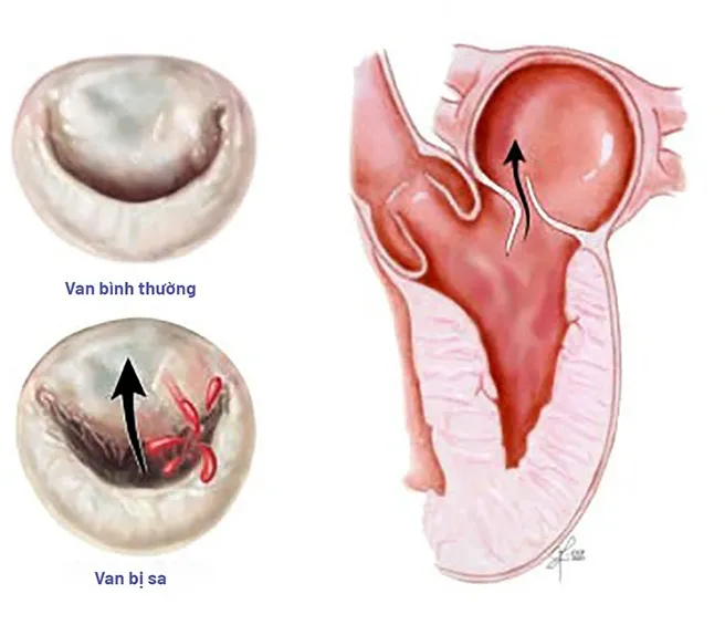 Tìm hiểu nguyên nhân gây bệnh hở van tim 2 lá