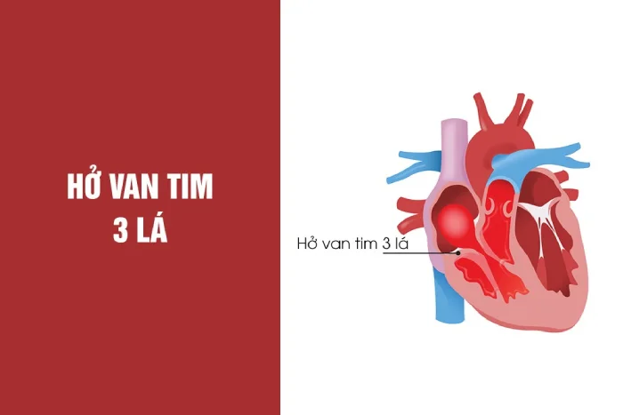 Tìm hiểu về bệnh hở van tim 3 lá 1/4 có nguy hiểm không?