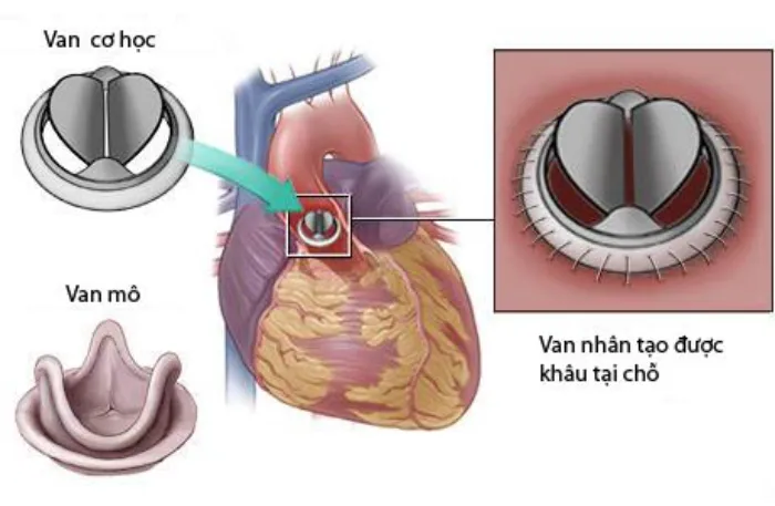 Tổng hợp các phương pháp điều trị bệnh hở van tim 2 lá