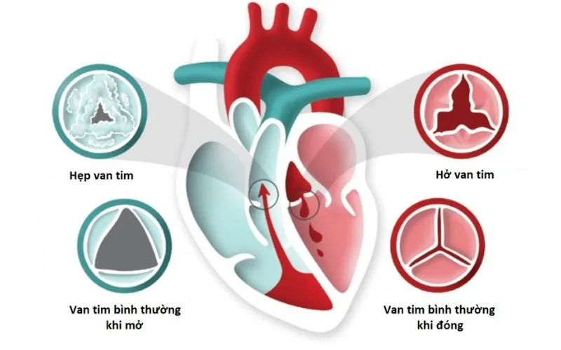 Hở van tim là tình trạng van tim không đóng kín
