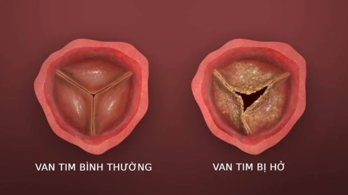 Tìm hiểu về bệnh hở van tim 1/4