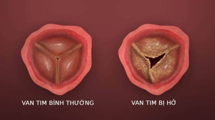 Bệnh hở van tim sống được bao lâu?