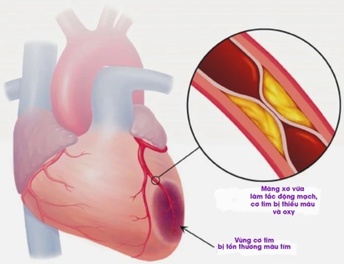 Hở van tim 1/4: Nguyên nhân và phương pháp điều trị
