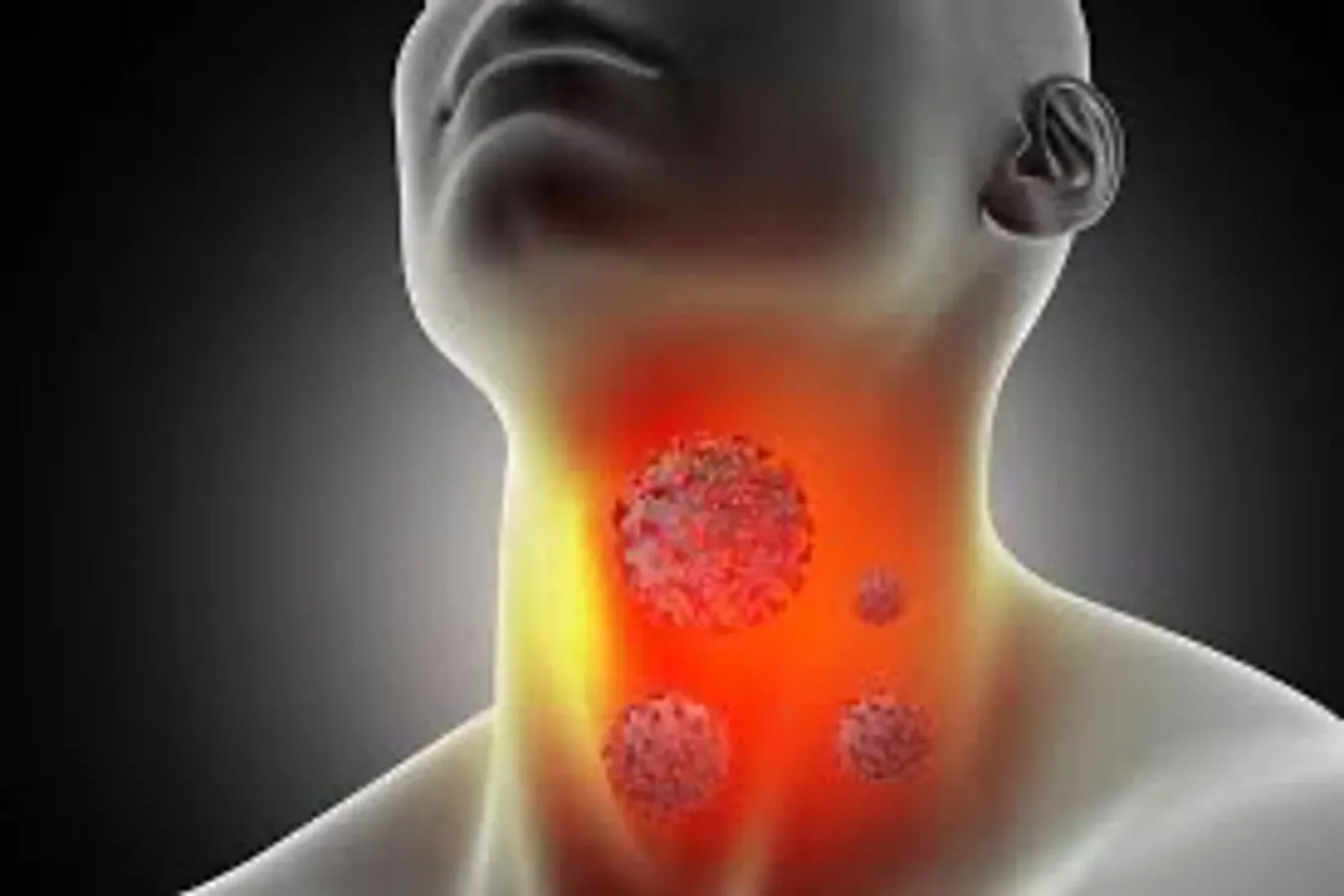 Tổng hợp các nguyên nhân gây ra ung thư vòm họng