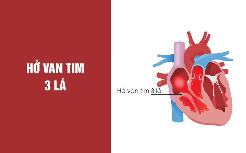 Hở van tim 3 lá ở thai nhi 