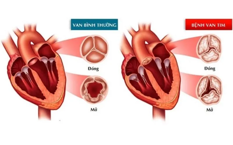 Bệnh hở van tim khiến dòng máu chảy bị trào ngược 