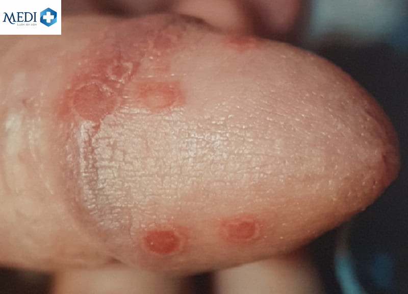 Mọc mụn ở dương vật có sao không? Khi nào cần đi khám bác sĩ?