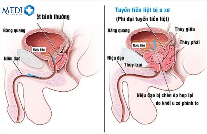 Nguyên nhân gây ra tiểu buốt ở nam giới
