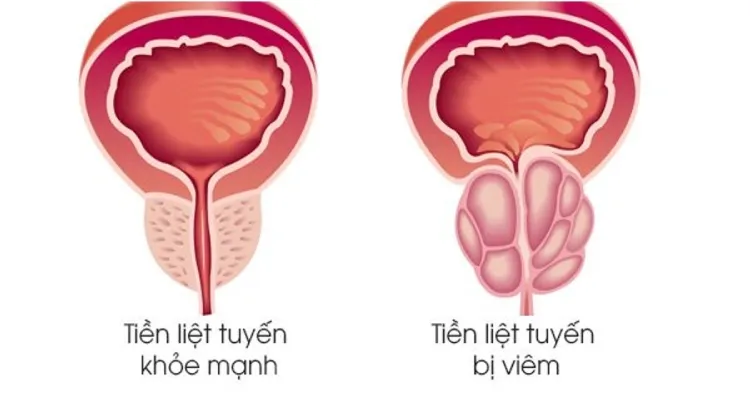 Đau dương vật sau khi quan hệ