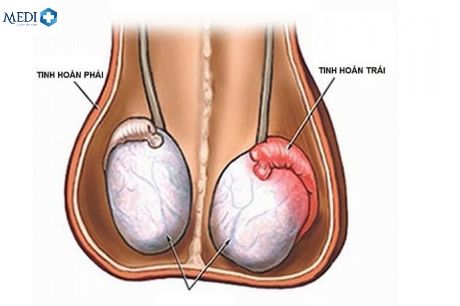 Đau tinh hoàn bên trái có hậu quả nguy hiểm không?
