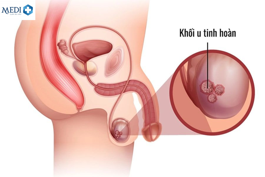 Khối u gây đau tinh hoàn bên trái