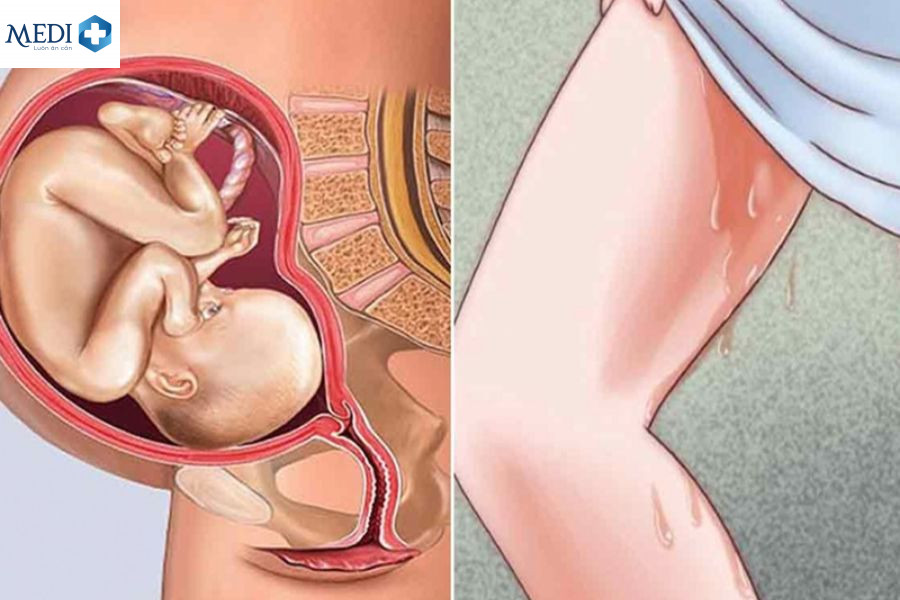 Vỡ ối mà tử cung chưa mở có nguy hiểm không? 4 lưu ý cho mẹ