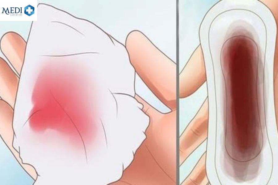 Quan hệ ra máu sau khi hết kinh 1 ngày có thể do lượng máu kinh còn sót lại