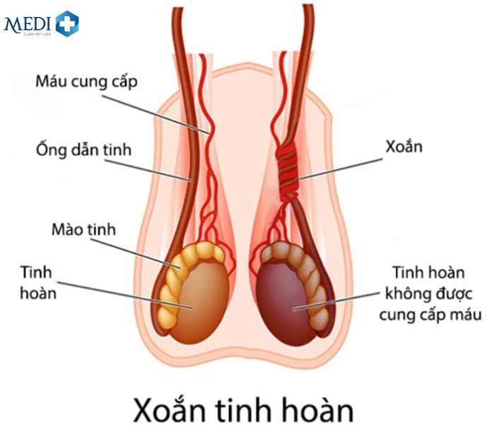 Xoắn tinh hoàn nguyên nhân dẫn đến đau tinh hoàn bên phải