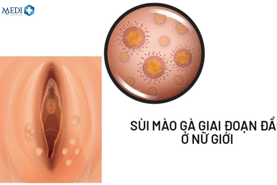 Sùi mào gà âm đạo có nguy hiểm không? 2 cách điều trị