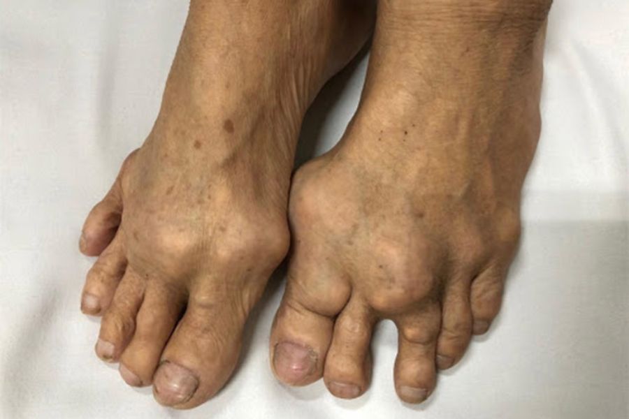 Bệnh gout có chữa khỏi được không? 4 cách chữa và 3 lưu ý