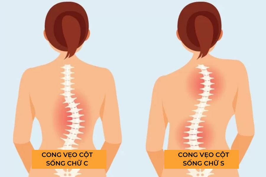 Hai loại cong vẹo cột sống thường gặp Vẹo cột sống chữ C và Vẹo cột sống chữ S