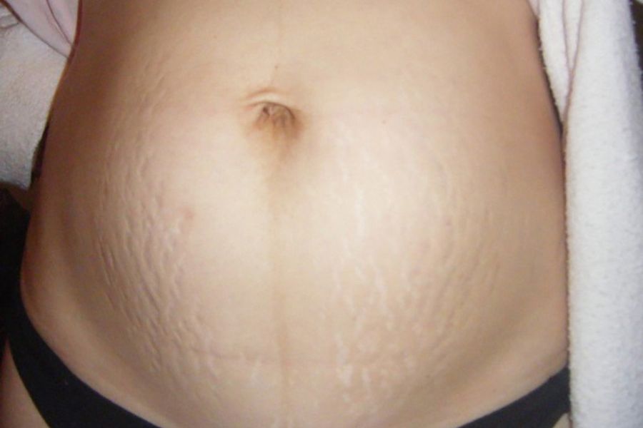 Những điều cần lưu ý khi chăm sóc và điều trị rạn da sau sinh cho mẹ bầu