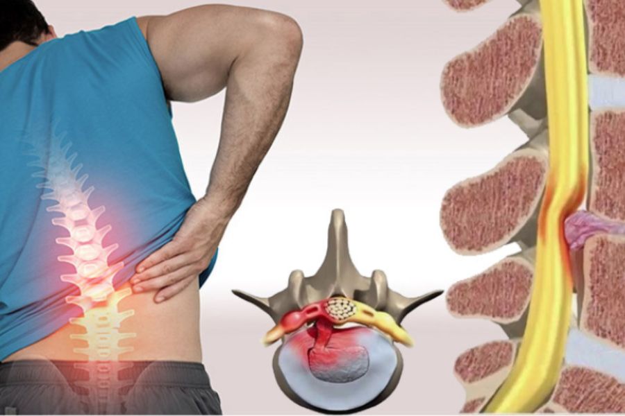 Thoát vị đĩa đệm là một biến chứng của vôi hoá cột sống
