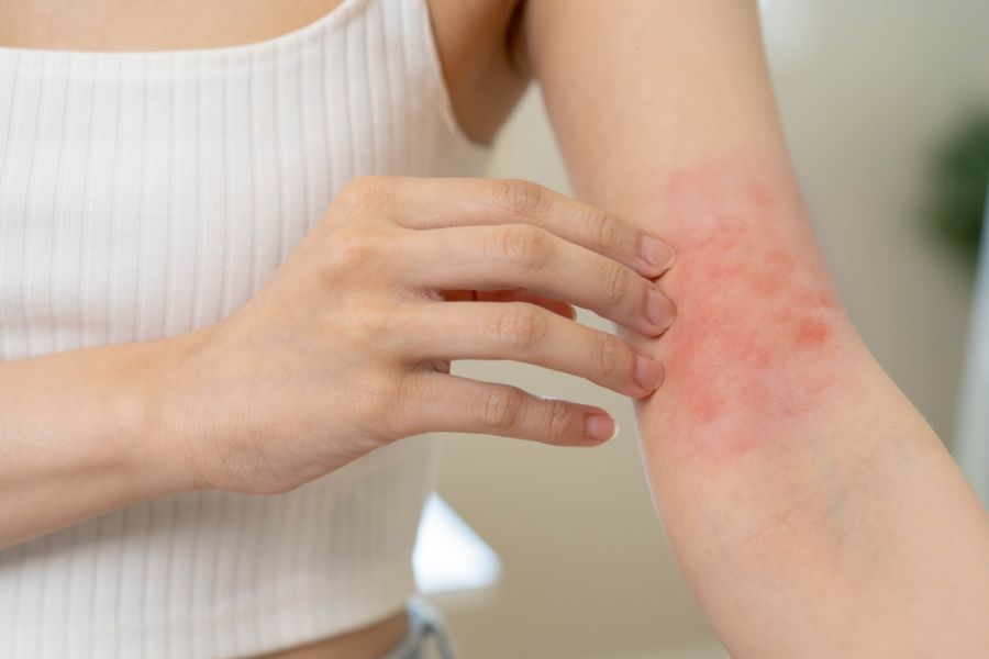 Nổi mề đay khi mang thai 3 tháng cuối có nguy hiểm không?