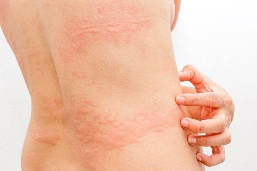 Dị ứng thực phẩm gây sẩn ngứa, nổi mề đay khi mang thai