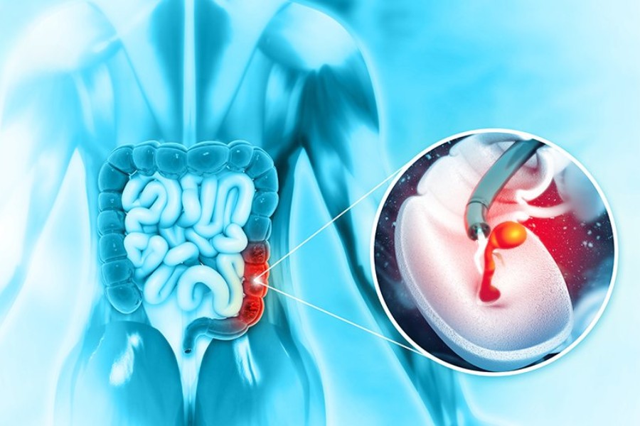 Cắt polyp đại tràng có mọc lại không? 5 Cách phòng ngừa