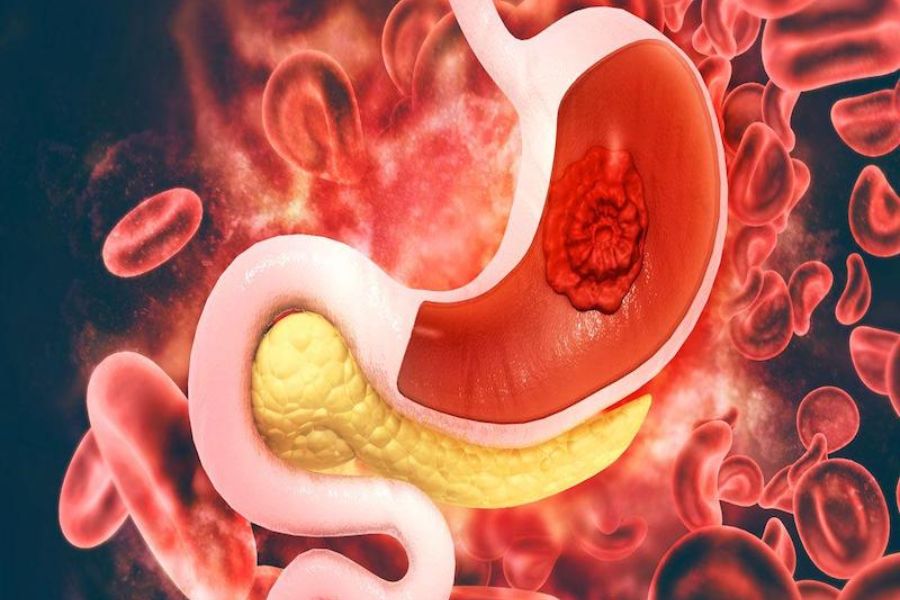 Đau dạ dày tiêu chảy: 3 nguyên nhân và 2 cách chữa