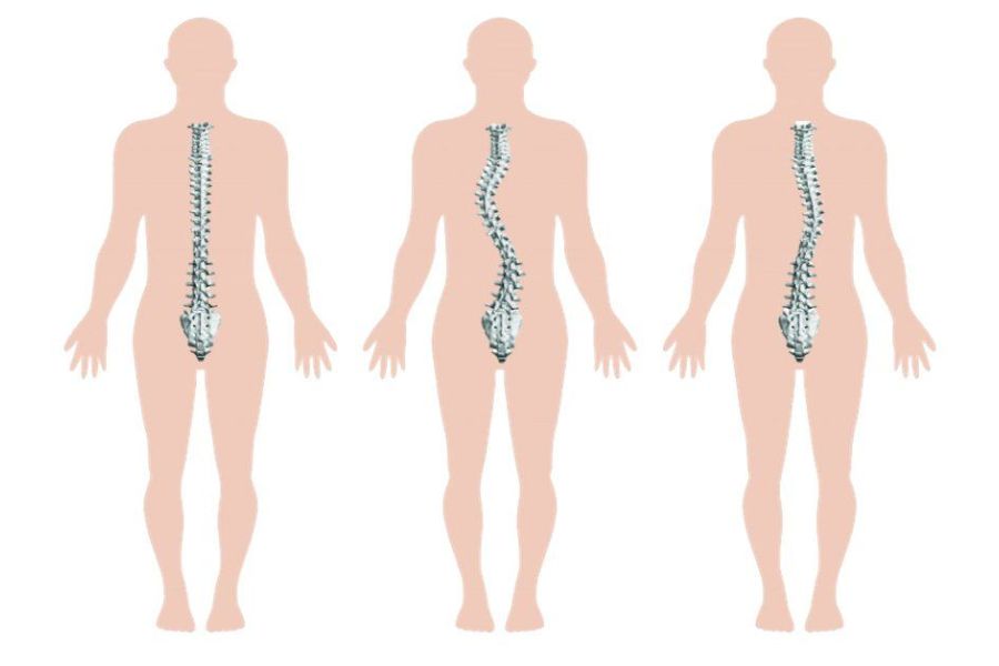 Cong vẹo cột sống làm ảnh hưởng đến dáng đi của mọi người