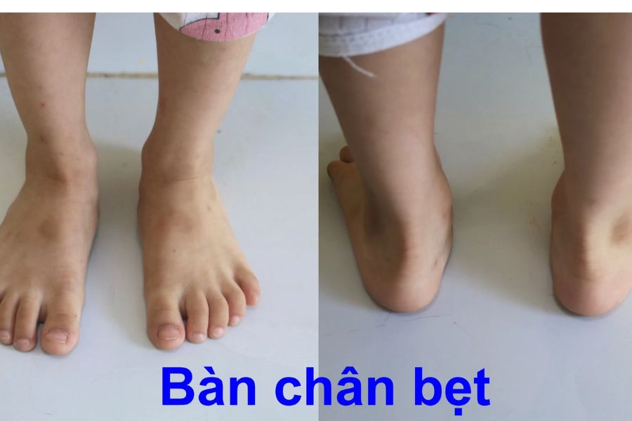 Cấu trúc xương bàn chân bình thường và bàn chân bẹt
