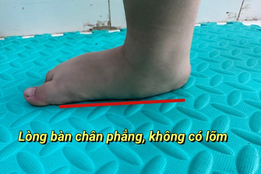 3 Cách chữa bàn chân bẹt ở trẻ em và 4 cách tập tại nhà
