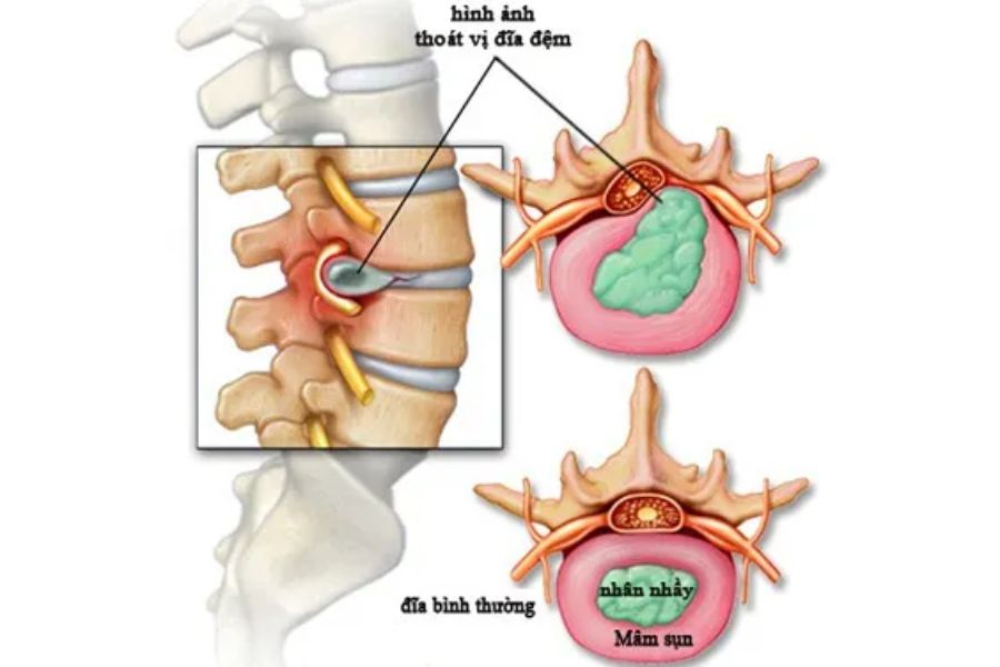 Khám cột sống cổ ở đâu tốt? 5 Dấu hiệu cần đi khám