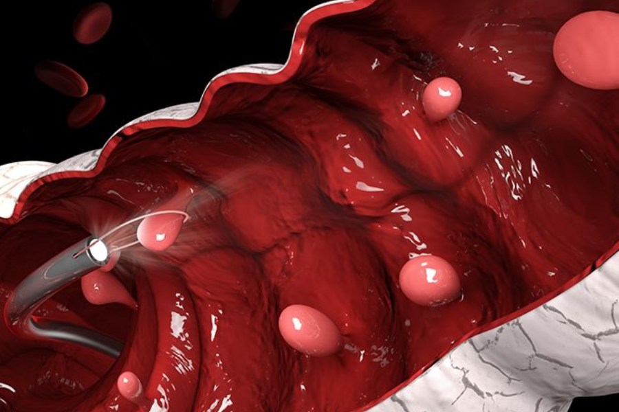 Polyp đại tràng ác tính khi nào? 3 phương pháp chẩn đoán
