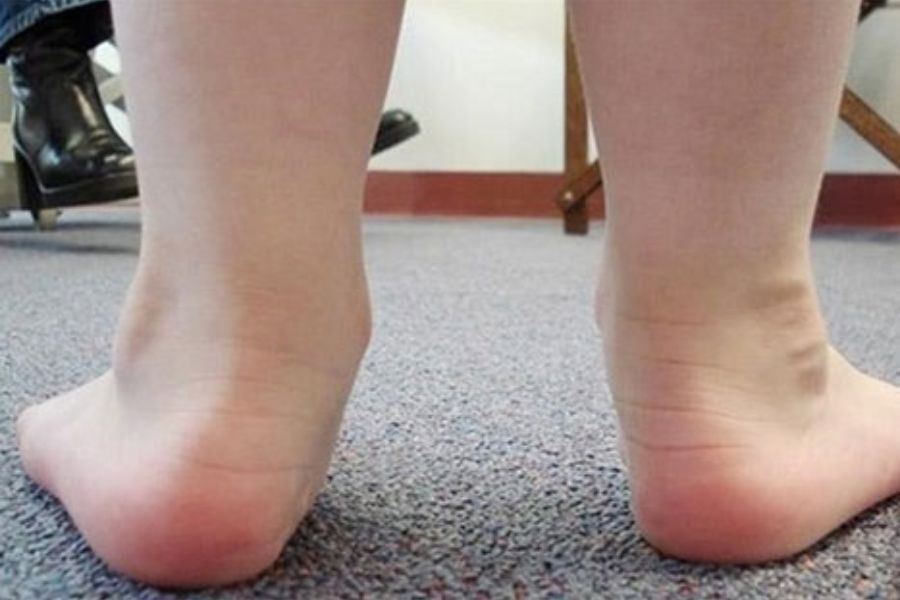 Bàn chân bẹt ở trẻ: 6 Nguyên nhân và 3 Cách điều trị