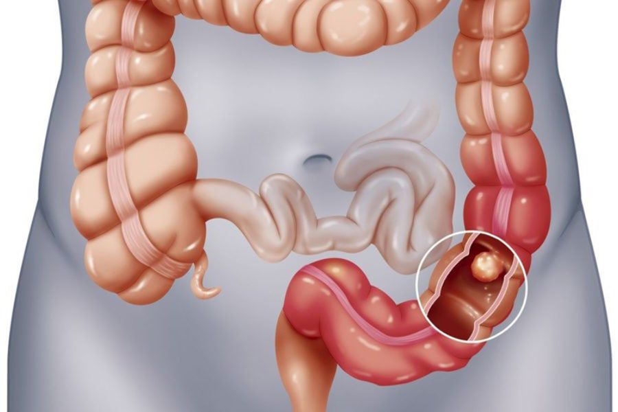 Đậu nành không phù hợp với người bị viêm ruột