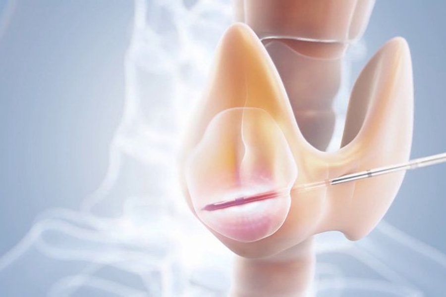 Nên đốt u tuyến giáp bằng sóng cao tần để điều trị bệnh