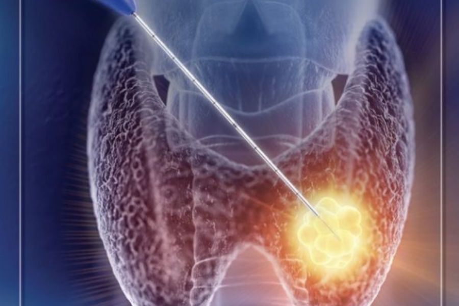 Một số trường hợp không nên đốt u tuyến giáp bằng sóng cao tần