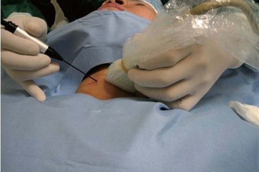 Đốt u tuyến giáp bằng sóng cao tần mang lại hiệu quả cao, an toàn và thẩm mỹ