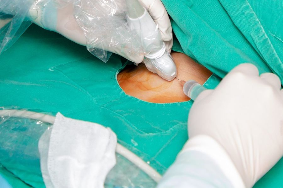 Đốt bướu cổ bằng sóng cao tần ít biến chứng, không cần nằm viện