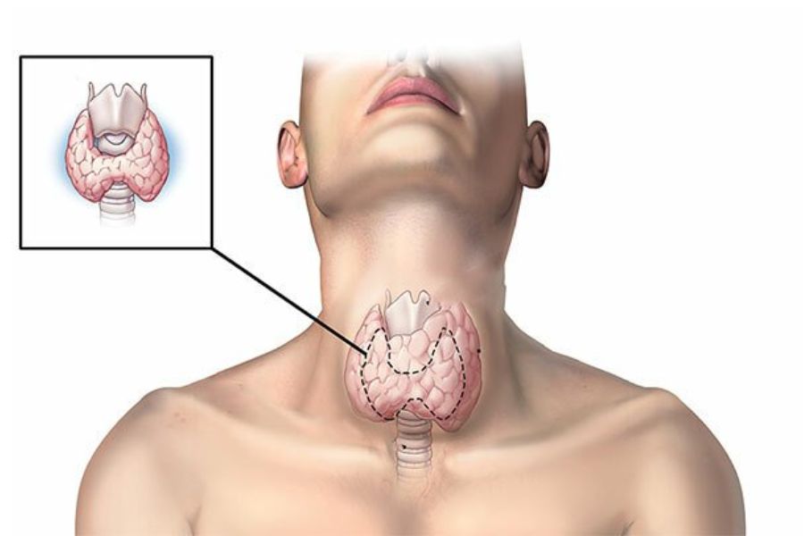U tuyến giáp (bướu cổ) là gì? tình trạng tuyến giáp phát triển bất thường
