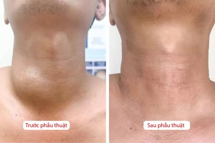 Phương pháp mổ u tuyến giáp mới nhất là cắt thùy tuyến giáp 