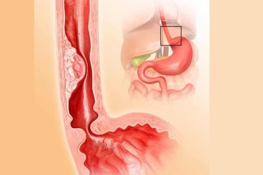 Uống đồ có nóng có thể gây bỏng niêm mạc thực quản và để lại sẹo