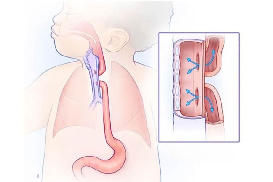 Teo thực quản bẩm sinh là một loại dị tật hiếm gặp