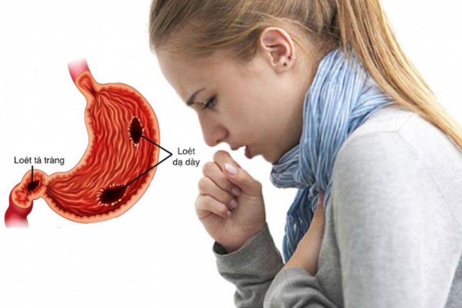 Trào ngược dạ dày gây ho đờm: 3 Nguyên nhân và 2 Cách chữa