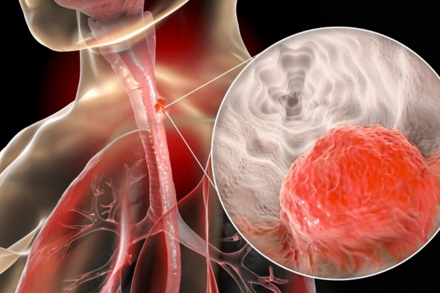 Trào ngược dạ dày nghẹn cổ họng khá nguy hiểm